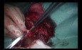 Uniportal VATS Sleeve Bilobectomy (Right Main Bronchus to RUL)