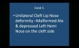 Unilateral Cleft Lip Nose Deformity, Correction