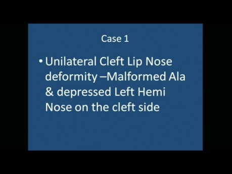 Unilateral Cleft Lip Nose Deformity, Correction