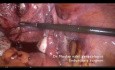 Standard laparoscopic polymyomectomy