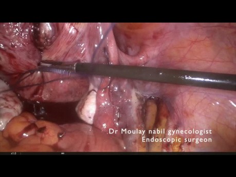 Standard laparoscopic polymyomectomy