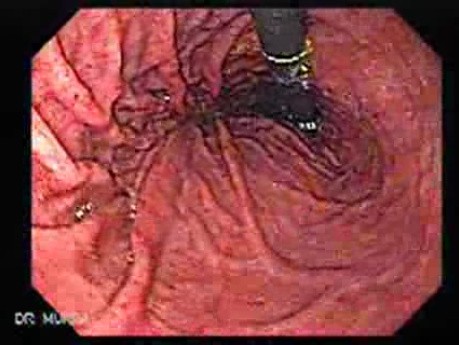 Acute Gastritis (6 of 6)
