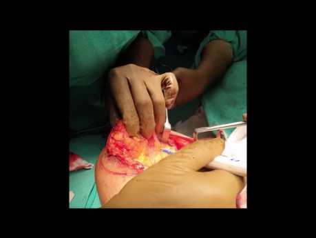 Breast Conservation Surgery (Round Block Donut Mastopexy) for Breast Cancer