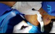 Laser Treatment of Anal Fistula