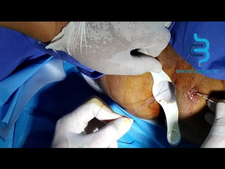 Laser Treatment of Anal Fistula