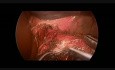 Laparoscopic Heller's Cardiomyotomy in 16 year-old Patient