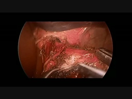 Laparoscopic Heller's Cardiomyotomy in 16 year-old Patient
