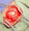 Epicranial Tumor Injury