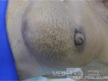Breast Cancer 