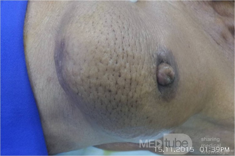 Breast Cancer 