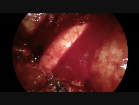 Complex Uniportal VATS Left Lower Lobectomy in a Destroyed Lobe