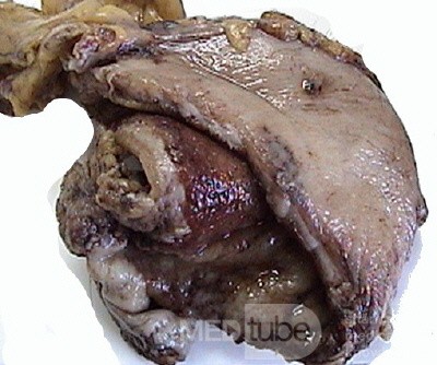 Plastic Linitis with bilateral Krukenberg´s tumor (13 of 13)