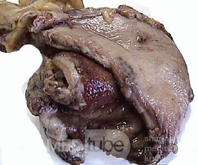 Plastic Linitis with bilateral Krukenberg´s tumor (13 of 13)