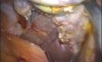 Laparo-Endoscopic Single Site (LESS) Cholecystectomy Without General Anesthesia