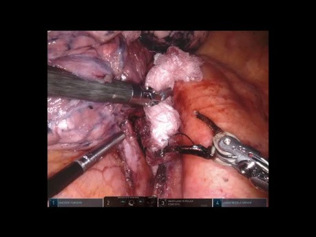 Left Bronchoplasty
