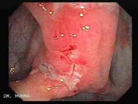 Colon Angiodysplasia (13 of 24)