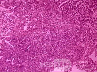 Cholangiocarcinoma that infiltrated a Periampullary Duodenal Diverticula and the head of the pancreas (20 of 20)
