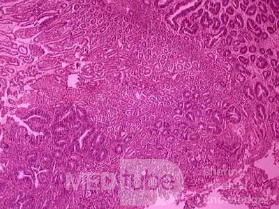 Cholangiocarcinoma that infiltrated a Periampullary Duodenal Diverticula and the head of the pancreas (20 of 20)