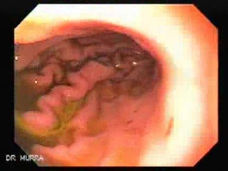 Gastroduodenal MALT lymphoma (1 of 9)