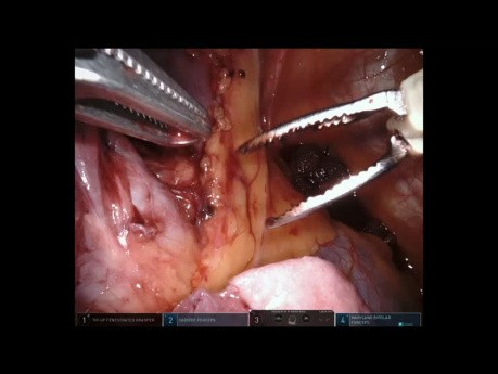 Right Upper Lobectomy