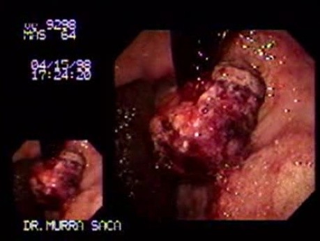 Adenocarcinoma of the Gastric Fundus - Endoscopy