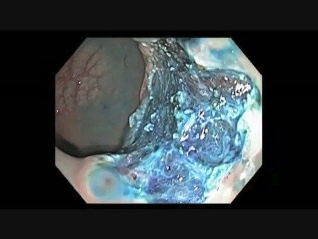 F Submucosal Chromoendoscopy