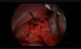 Laparoscopy For Torsion with Cyst and Second Look