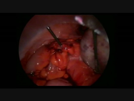 Laparoscopy For Torsion with Cyst and Second Look