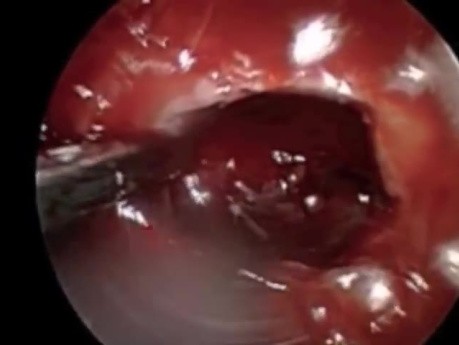Pituitary Macroadenoma with Hemorrhage