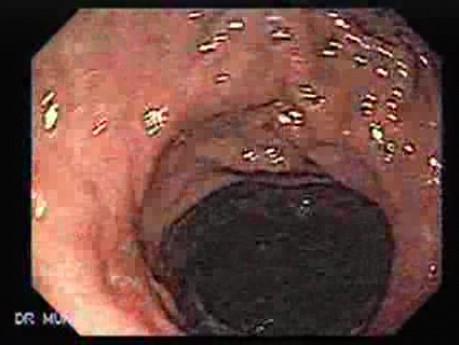 Hourglass Stomach - Closer Look at the Recovered Mucosa