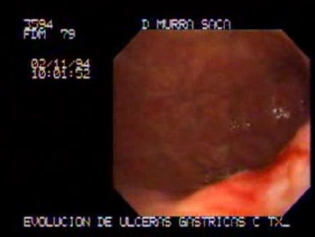 Large Ramified Ulcer of the Stomach (2 of 3)