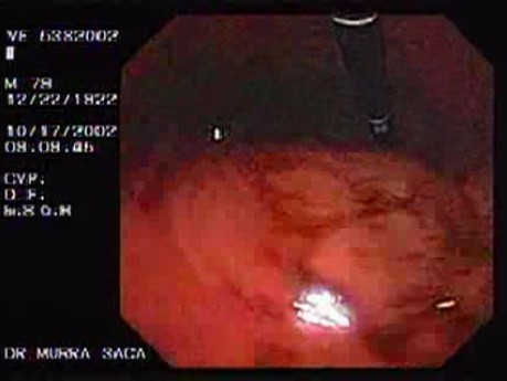 Duodenal Ulcer and Bleeding (1 of 4)