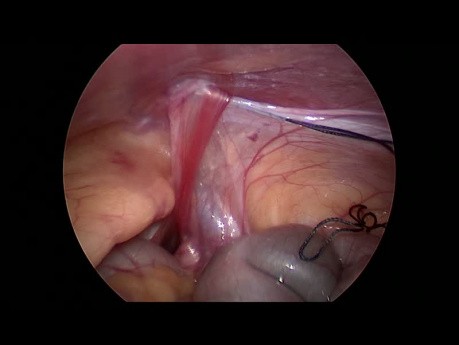 Laparoscopic Right Inguinal Hernia Repair in a 3-Year-Old Female Child