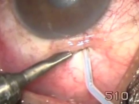 Transciliary Filtration - Singh Method