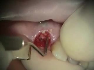 Immediate Implant And Transition With Stayplate