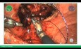 Robotic-Assisted Prostatectomy