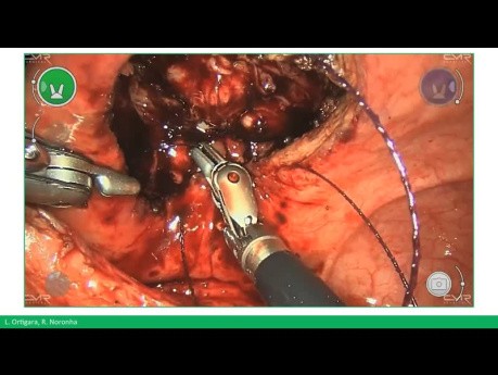 Robotic-Assisted Prostatectomy