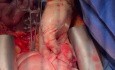 ANRP and Total Inflow Occlusion of the Chest with 4 Clamps Techniques 
