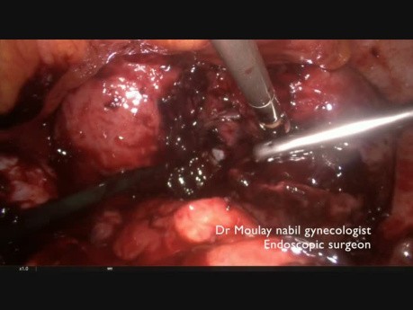 Emergency Laparoscopy for Ectopic Pregnancy