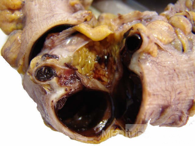 Surgical Resection Specimen
