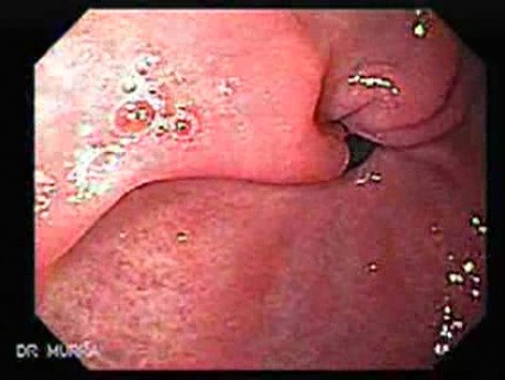 Watermelon Stomach (1 of 7) - Treatment with Argon Plasma Coagulator (APC)