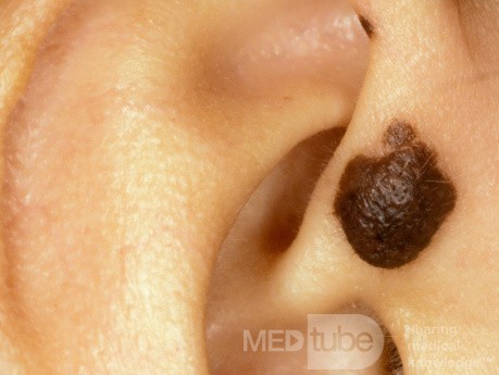 Intradermal Nevus