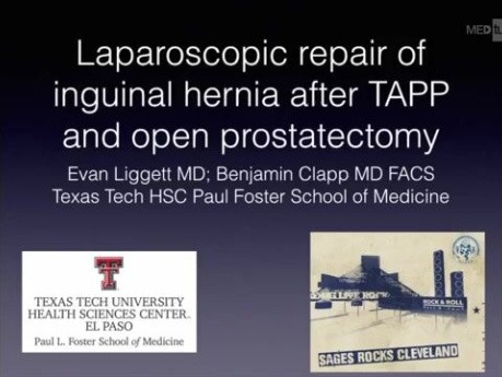 Laparoscopic Repair of Inguinal Hernia After TAPP and Open Prostatectomy