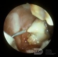 Oroantral Fistula [sinuscopic view]