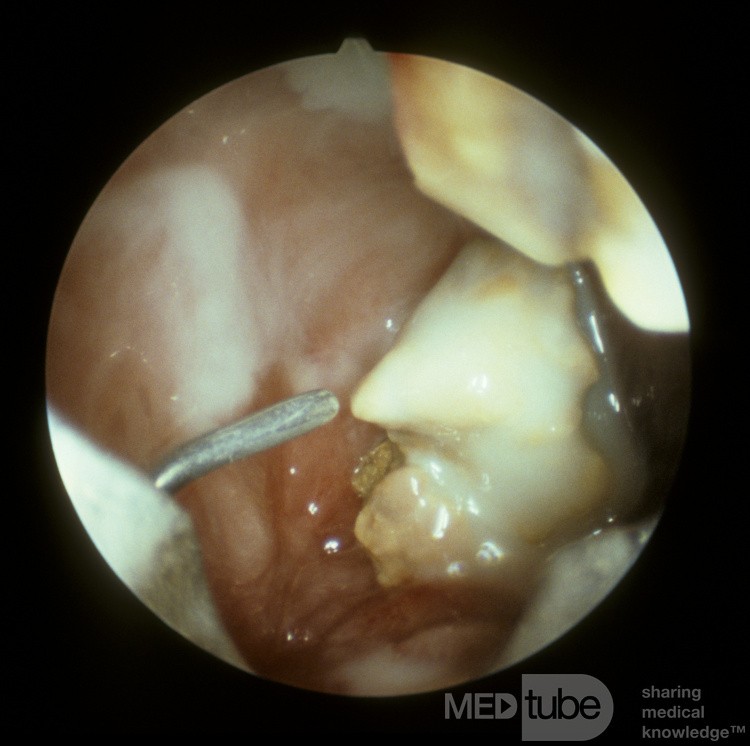 Oroantral Fistula [sinuscopic view]