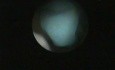 Endometrial polyp and endometritis in a patient with infertility under study