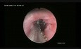 Removal of an Impacted Foreign Body from the Esophagus
