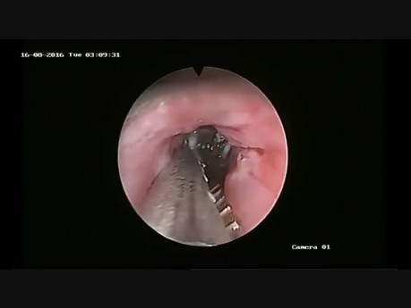 Removal of an Impacted Foreign Body from the Esophagus