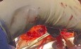 Important Issues of Heart and Liver En Bloc Final Edition 