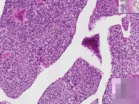 Transitional cell carcinoma